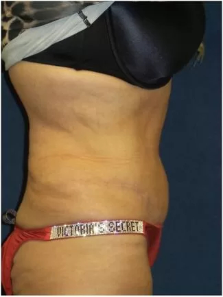 Tummy Tuck Before & After Patient #3401