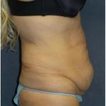 Tummy Tuck Before & After Patient #3401