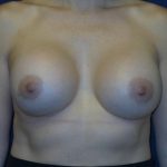 Breast Augmentation Before & After Patient #3414