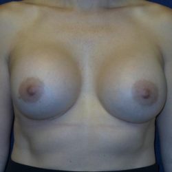 Breast Augmentation Before & After Patient #3414
