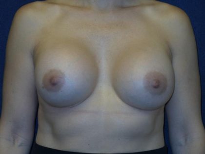 Breast Augmentation Before & After Patient #3414