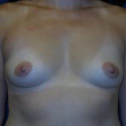Breast Augmentation Before & After Patient #3414