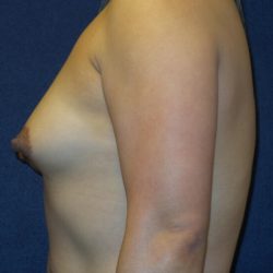 Breast Augmentation Before & After Patient #3421