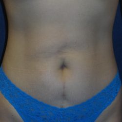 Liposuction Before & After Patient #3422
