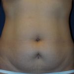 Liposuction Before & After Patient #3422