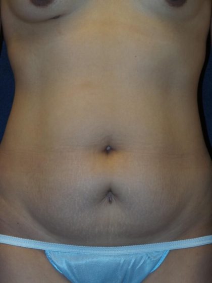 Liposuction Before & After Patient #3422