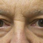 Blepharoplasty Before & After Patient #3439