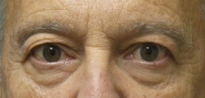 Blepharoplasty Before & After Patient #3439