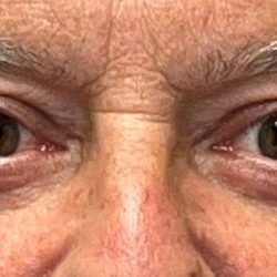 Blepharoplasty Before & After Patient #3439
