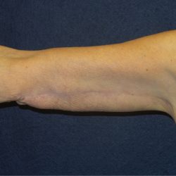 Arm Lift Before & After Patient #3443