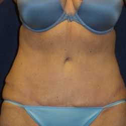 Tummy Tuck Before & After Patient #3442