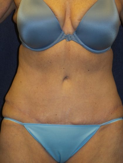 Tummy Tuck Before & After Patient #3442