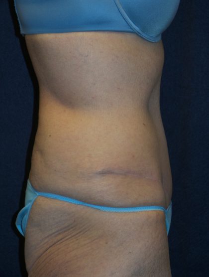 Tummy Tuck Before & After Patient #3442
