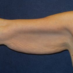 Arm Lift Before & After Patient #3443
