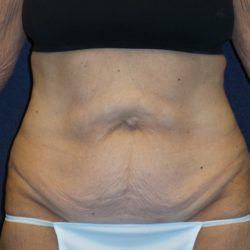 Tummy Tuck Before & After Patient #3442