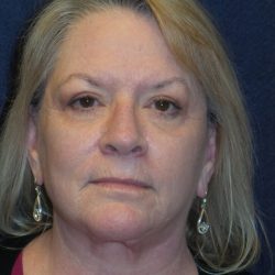 Facelift Before & After Patient #3458