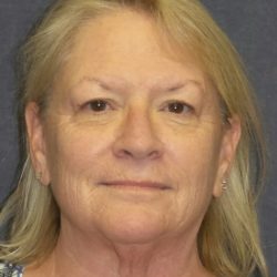 Facelift Before & After Patient #3458