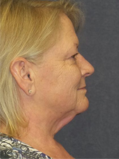 Blepharoplasty Before & After Patient #3458