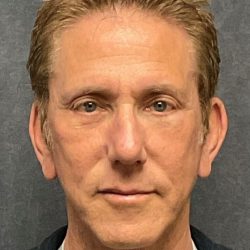 Facelift Before & After Patient #3453