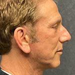 Facelift Before & After Patient #3453