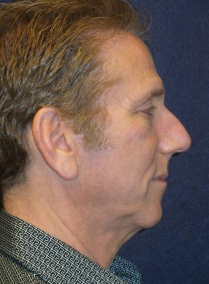 Facelift Before & After Patient #3453