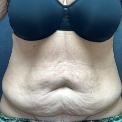 Tummy Tuck Before & After Patient #3477