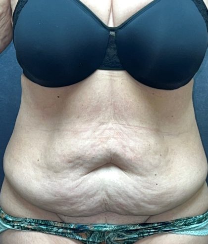 Abdominoplasty Before & After Patient #3477