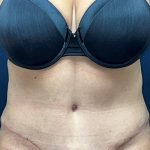 Abdominoplasty Before & After Patient #3477