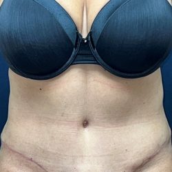 Tummy Tuck Before & After Patient #3477