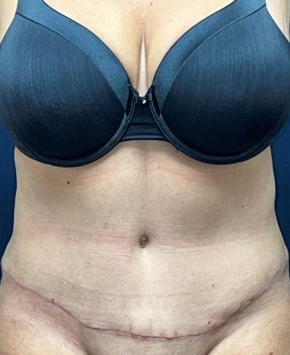 Abdominoplasty Before & After Patient #3477