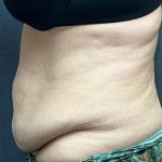 Abdominoplasty Before & After Patient #3477