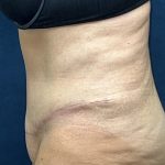 Abdominoplasty Before & After Patient #3477