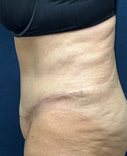 Abdominoplasty Before & After Patient #3477