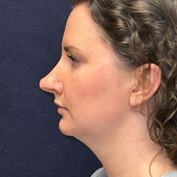 Neck Lift Before & After Patient #3490