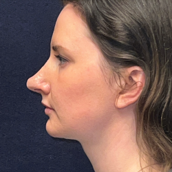 Neck Lift Before & After Patient #3490