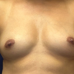 Breast Augmentation Before & After Patient #3533