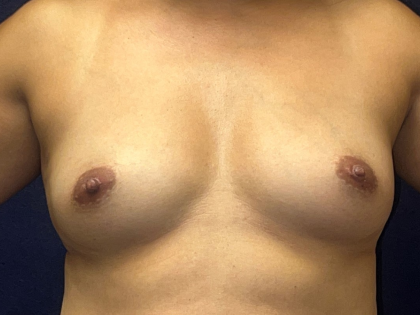 Breast Augmentation Before & After Patient #3533