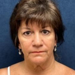 Facelift Before & After Patient #3526