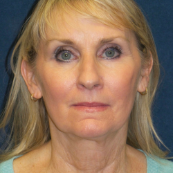 Neck Lift Before & After Patient #3545
