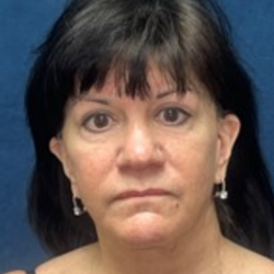 Facelift Before & After Patient #3526