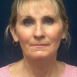 Neck Lift Before & After Patient #3545