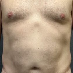 Liposuction Before & After Patient #3561