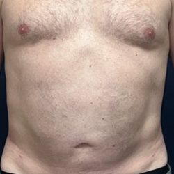 Liposuction Before & After Patient #3561