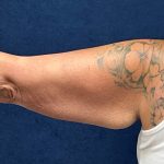 Arm Reduction Before & After Patient #3579