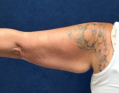 Arm Reduction Before & After Patient #3579
