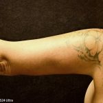 Arm Reduction Before & After Patient #3579