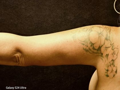 Arm Reduction Before & After Patient #3579