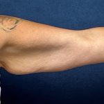 Arm Reduction Before & After Patient #3579