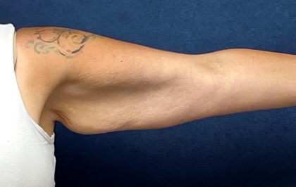 Arm Reduction Before & After Patient #3579