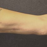 Arm Reduction Before & After Patient #3579